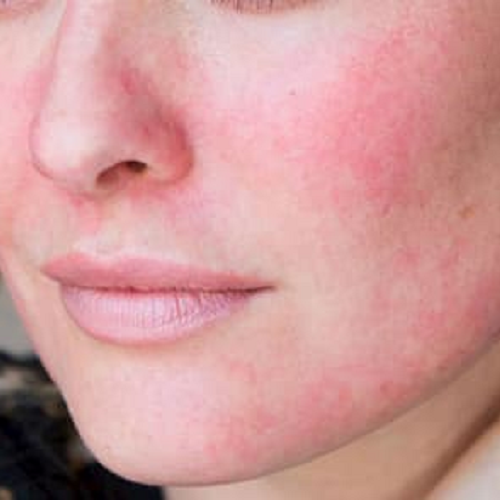 Da mặt ửng đỏ, có thể do tiếp xúc với chó bị ghẻ.